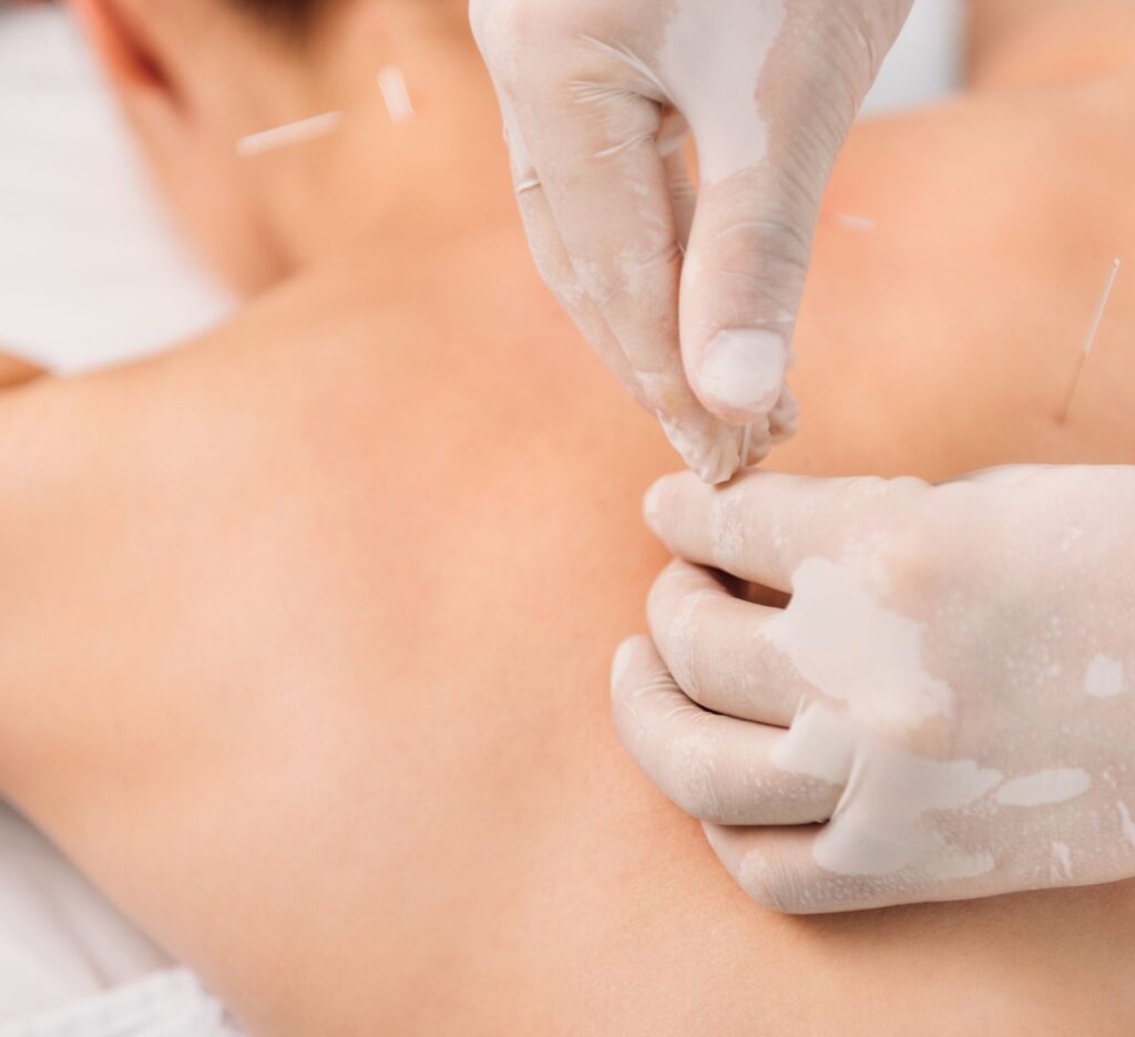 Dry Needling Hampton