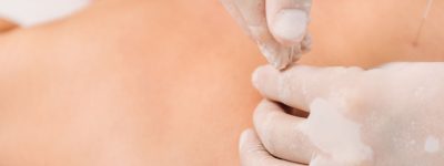 Dry Needling Hampton